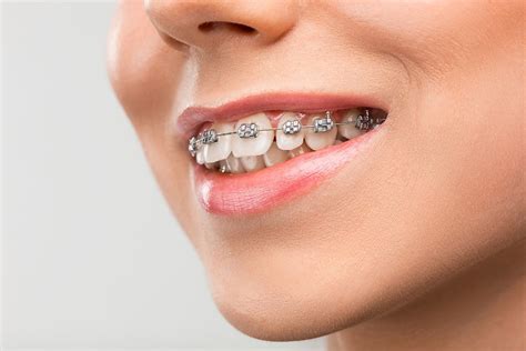 juego de brackets metalicos|Brackets Metálicos: Una Guía Completa de Ortodoncia.